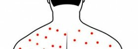 body-acne-illustration