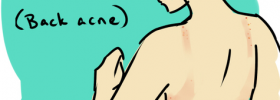 back_acne_causes